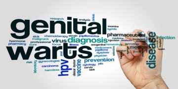 درمان زگیل تناسلی
