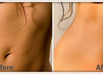 ترک های پوست یا استریا